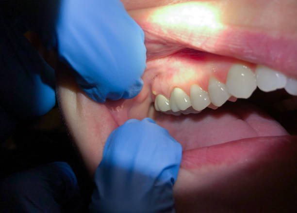 Best Dental Abscess Treatment in Thornton, IL